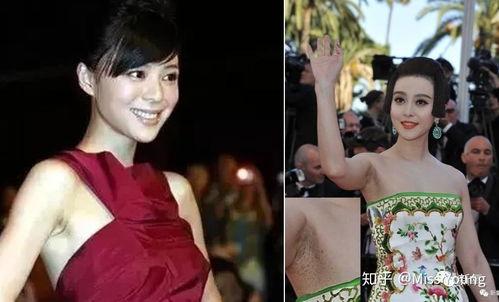 明星脱毛,光速告别毛发烦恼